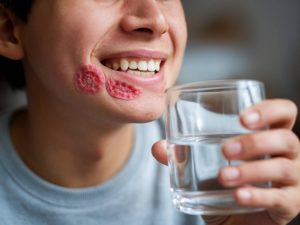 remède naturel aphtes : soulager la douleur et accélérer la guérison