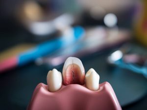 Les signes qui indiquent que vous devez consulter un dentiste rapidement